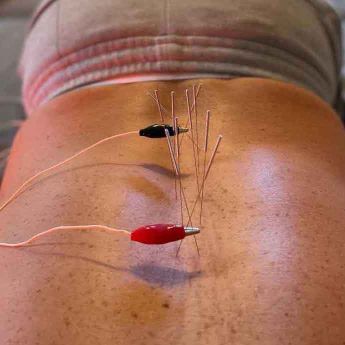electroacupuncture 