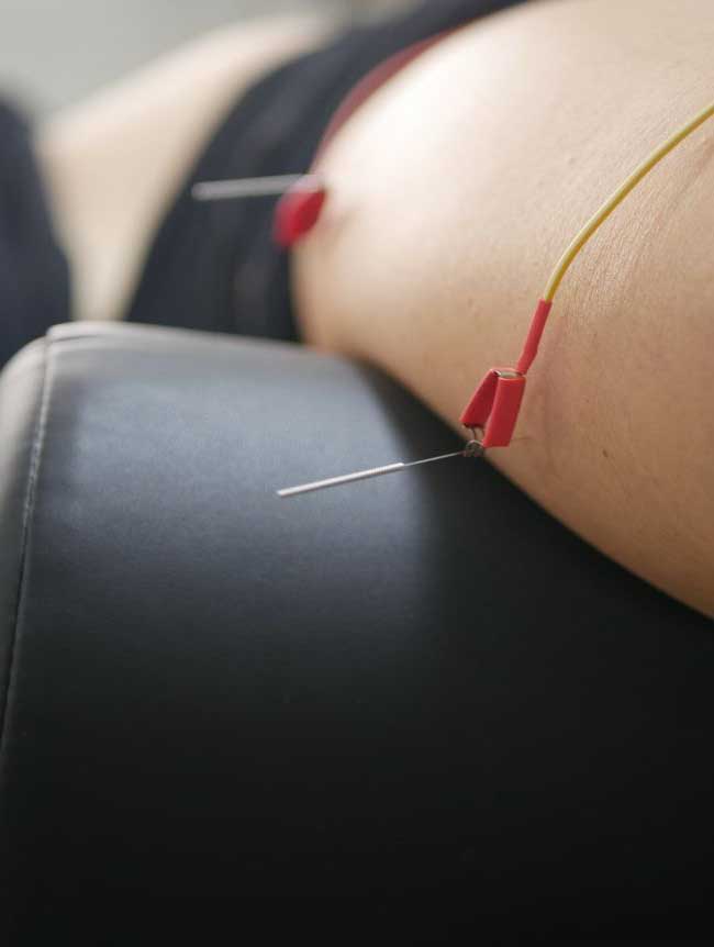 https://jackupuncture.com/wp-content/uploads/2023/05/electroacupuncture-vs.-acupuncture.jpg