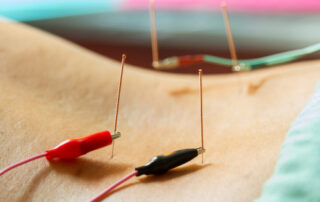 how acupuncture works for pain relief