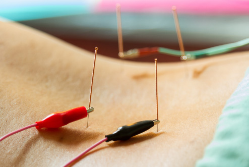 How Acupuncture Relieves Pain