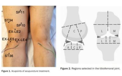Acupuncture vs Physical Therapy for Knee Osteoarthritis