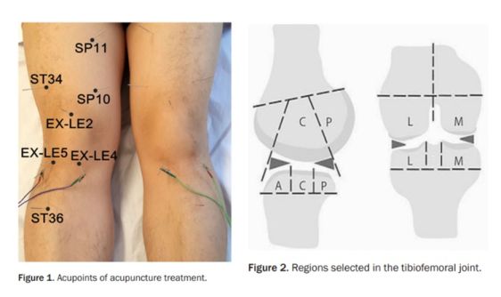Acupuncture vs Physical Therapy for Knee Osteoarthritis