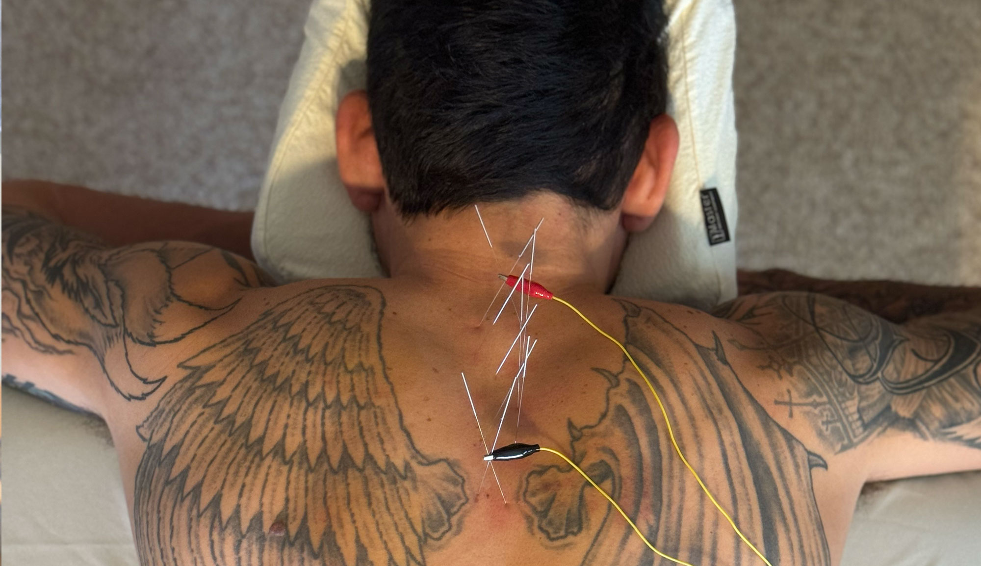 Jackupuncture back acupuncture session with electro-stimulation, promoting pain relief and muscle relaxation.