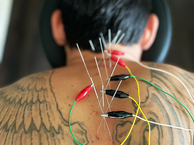 Electro-acupuncture treatment targeting back muscles, enhancing relaxation and promoting pain relief at Jackupuncture.