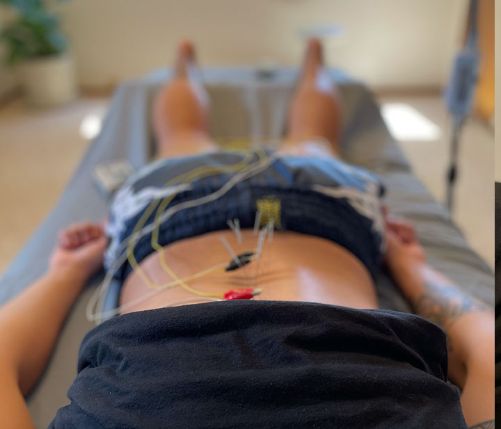 Close-up of acupuncture with electrical stimulation wires attached to the lower back